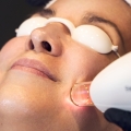 Tratamiento Facial IPL by Stellar M-22 - EVO Beauty Clinics