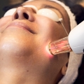 Tratamiento Facial Resur fx by Stellar M-22 - EVO Beauty Clinics