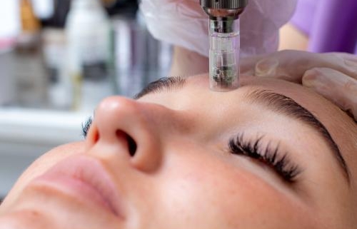 Microneedling facial: rejuvenece tu piel con microagujas - Evo Beauty