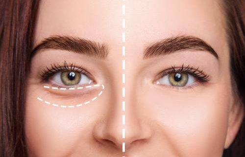 Elimina el cansancio de tu mirada con tratamientos estéticos - Evo Beauty