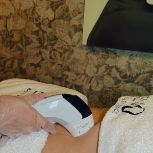 Ultraformer MPT - body