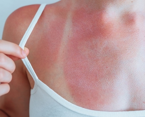 envejecimiento de la piel por el sol