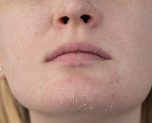 porque se deshidrata la piel