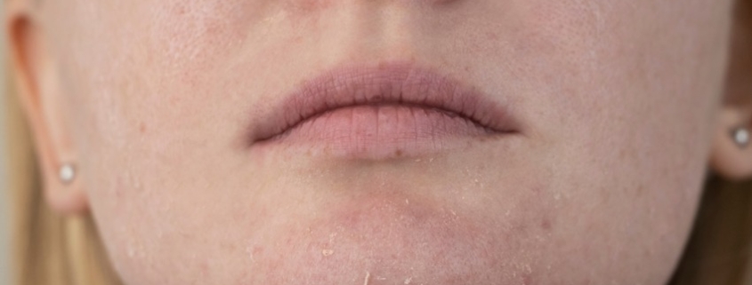 porque se deshidrata la piel