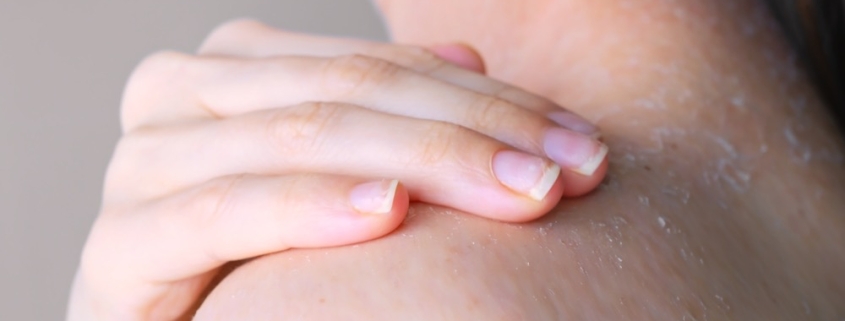 recomendaciones para una piel deshidratada