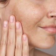 cómo eliminar las manchas de la cara