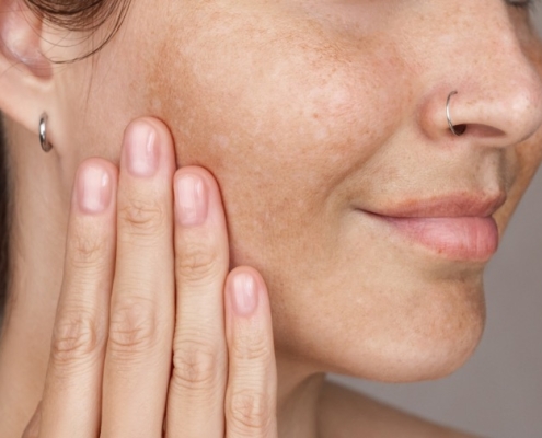 cómo eliminar las manchas de la cara