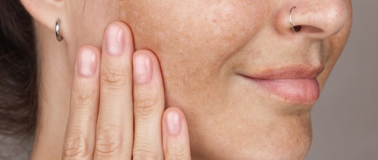 cómo eliminar las manchas de la cara