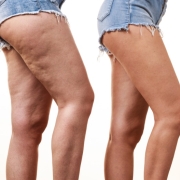 por qué salen celulitis en las piernas