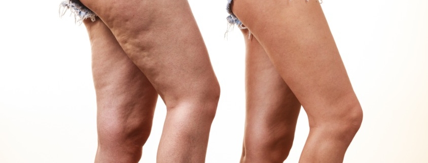 por qué salen celulitis en las piernas