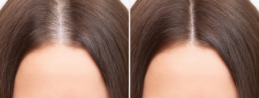 ¿Quieres el mejor tratamiento para la caída del cabello en la mujer?