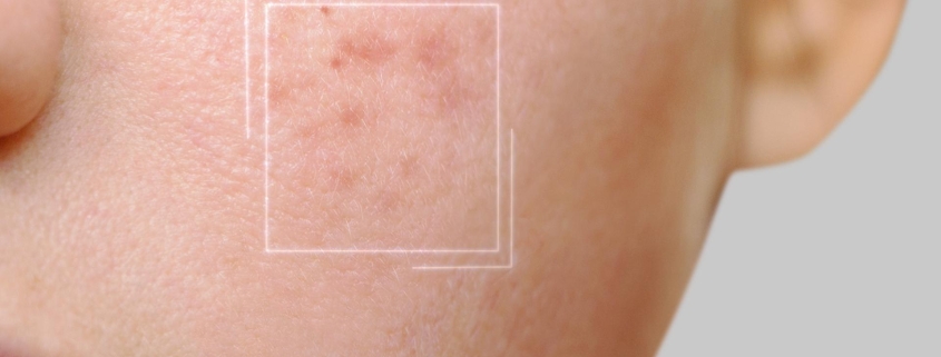 me ha salido una mancha en la piel