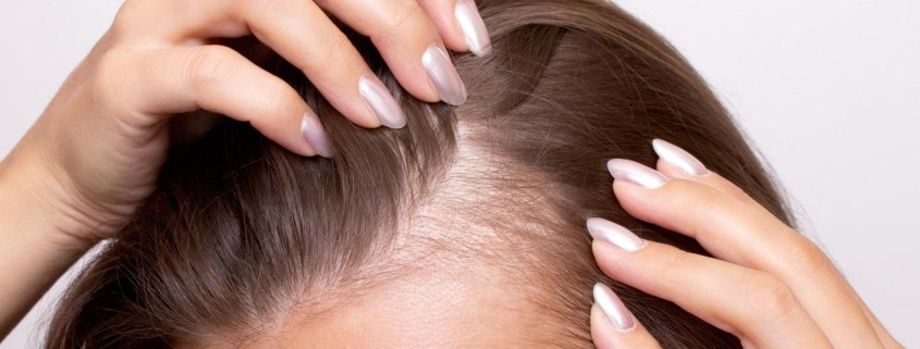 tratamiento para la caída del cabello en mujeres