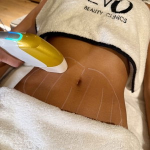 Ultraformer MPT - body