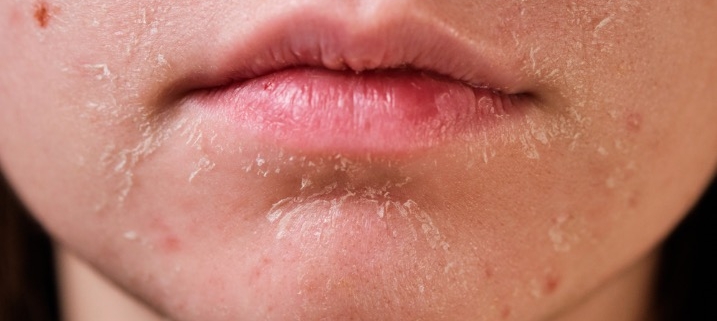 como se ve la deshidratación en la piel