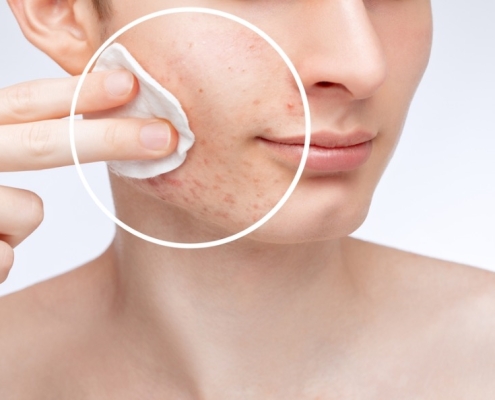 principios activos para piel grasa deshidratada