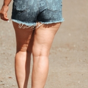 a que se debe la celulitis