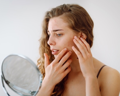 cómo quitar manchas de la piel