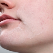 como recuperar una piel deshidratada