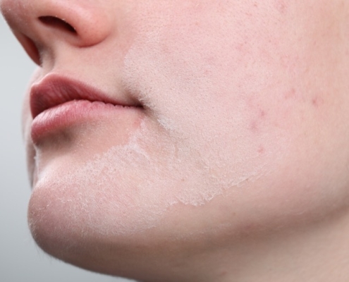 como recuperar una piel deshidratada