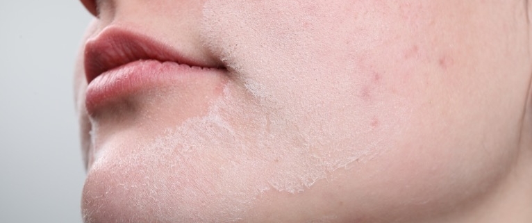 como recuperar una piel deshidratada