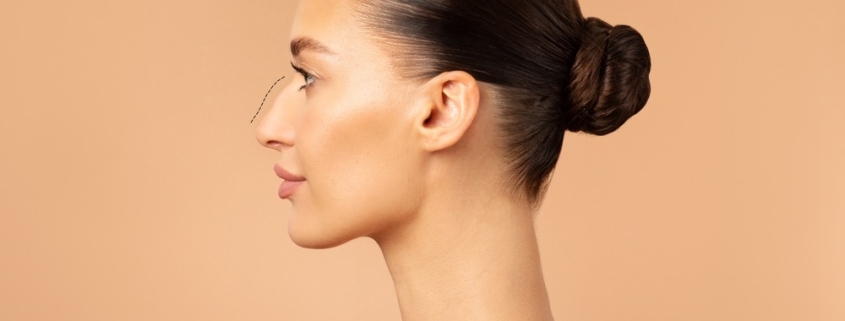 rinomodelacion punta caida