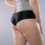 tratamiento celulitis