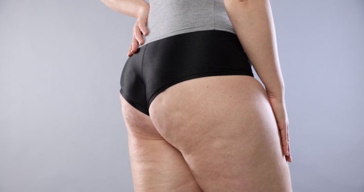 tratamiento celulitis