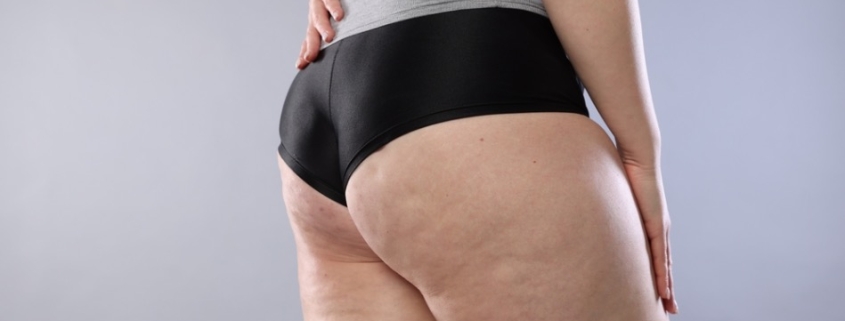 tratamiento celulitis