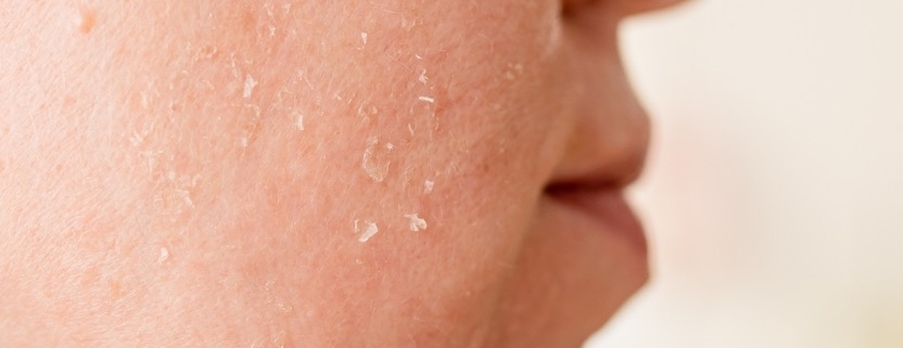 tengo la piel muy seca y escamosa que puedo hacer